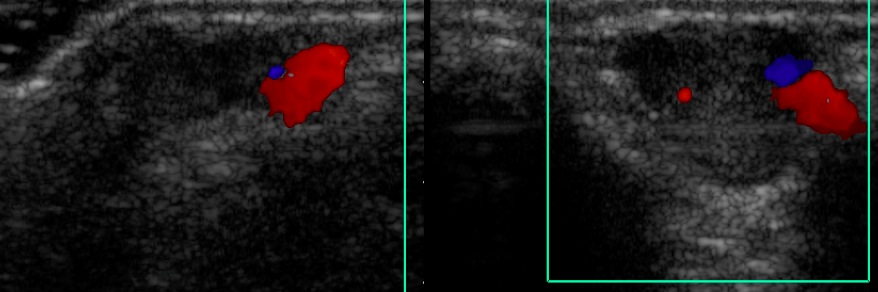 Figure 4 for case Venous malformation ( RID3337 )
